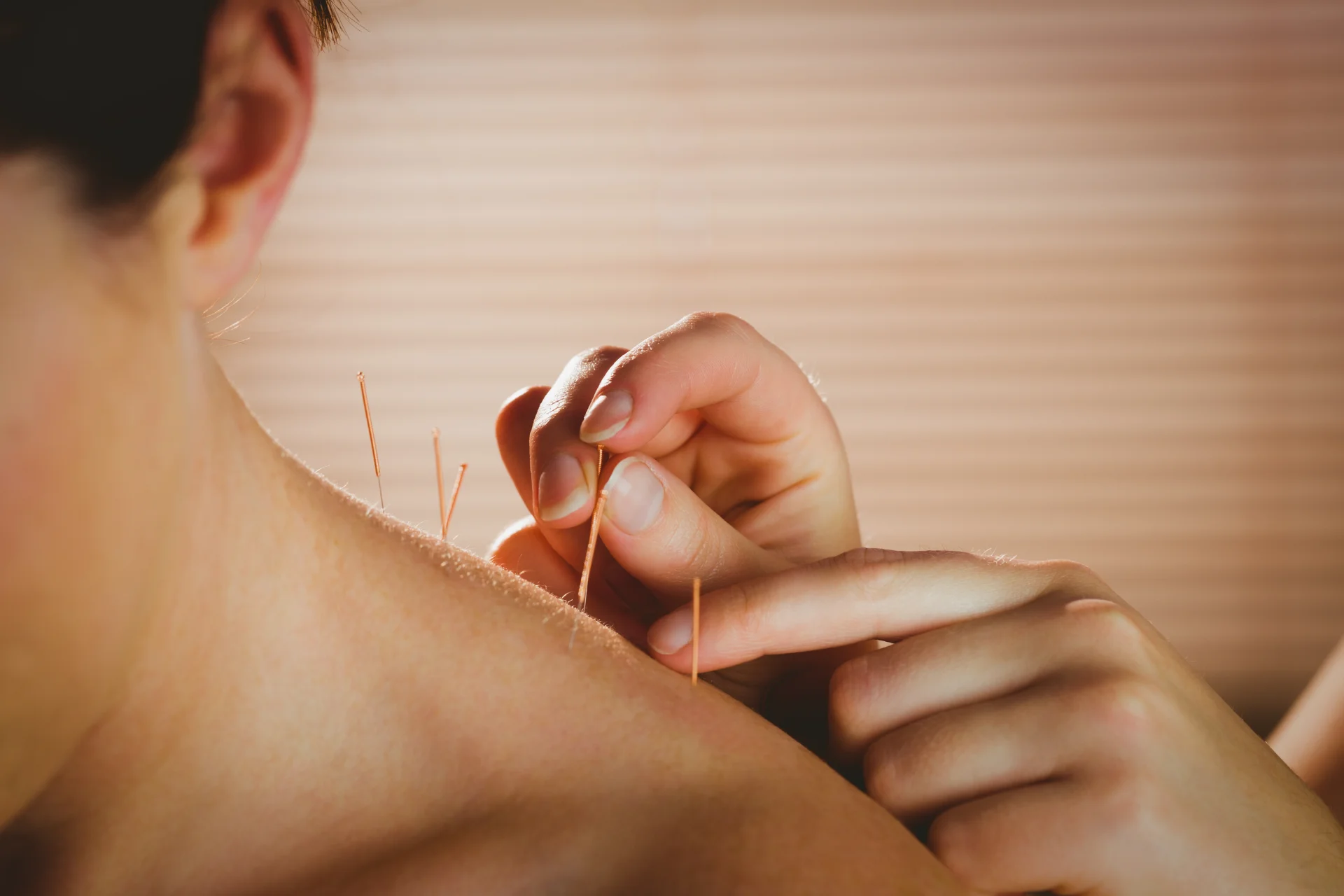 receiving acupuncture treatment for neck and shoul 2026 01 09 11 36 20 utc